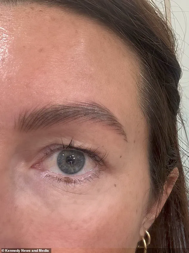 Exclusive Access: The £2,500 Eyelid Surgery That Transformed Sophie Watkins' Appearance