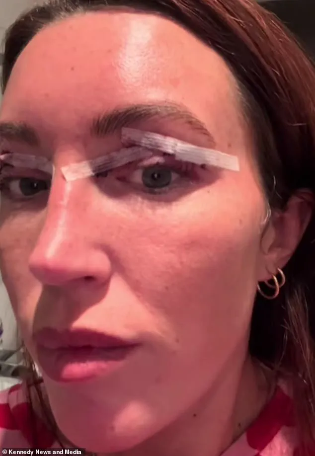 Exclusive Access: The £2,500 Eyelid Surgery That Transformed Sophie Watkins' Appearance
