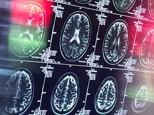 Breakthrough in Dementia Prediction: New Brain Imaging Technique Could Detect Alzheimer’s Years Before Symptoms Appear