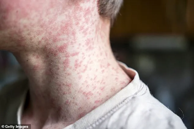 Utah Measles Outbreak: Unvaccinated Attendees at Cycling Event Pose Risk, Experts Urge Vaccination