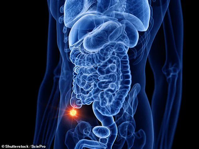 Limited Insights: Surge in Appendix Cancer Cases Among Younger Generations Sparks Medical Mystery