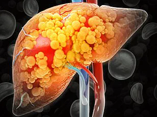 Silent Epidemic: 80–100 Million Adults in the U.S. May Live with Undiagnosed Fatty Liver Disease, Experts Warn