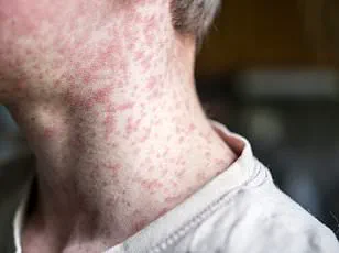 South Carolina Measles Outbreak: Department of Public Health Issues Urgent Advisory on Resurgence and Public Health Precautions