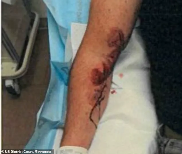 ICE Agent Jonathan Ross, Involved in Renee Good's Fatal Shooting, Details Previous Incident Where He Was Dragged 100 Yards by Suspect at 40mph, Sustaining Severe Scars