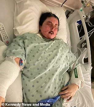 Severe Adverse Reaction to Lamotrigine Leaves Woman with Extensive Skin Loss