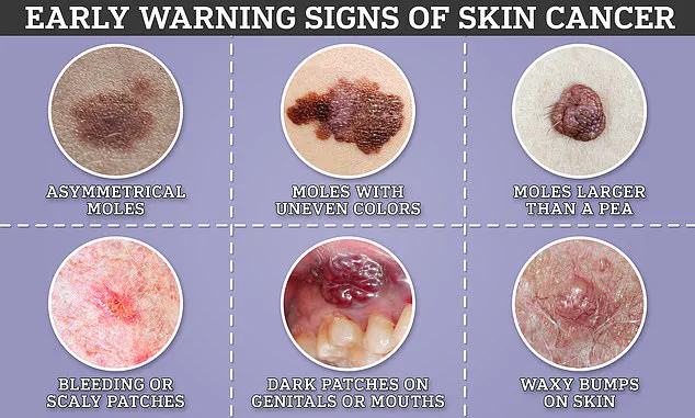 Melanoma's Hidden Threat: Recognizing Signs Beyond the Skin to the Eyes