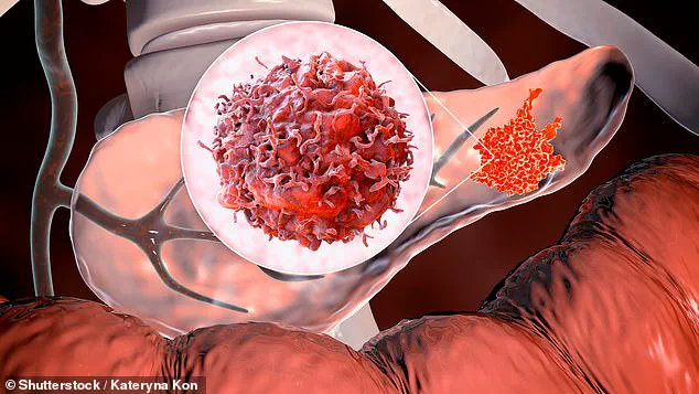 Breakthrough Blood Test Offers Early Pancreatic Cancer Detection, Improving Survival Rates