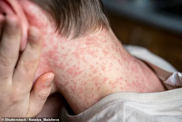 Measles Outbreak at Texas Immigration Detention Center Prompts ICE Lockdown, Health Officials Warn of Containment Challenges