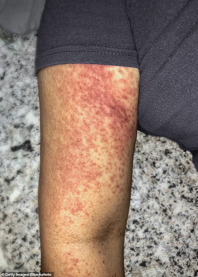 Chikungunya Virus Resurgence: 240,000+ Cases Reported in 16 Countries, CDC Issues Travel Advisories