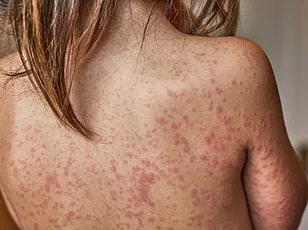 Health Officials Warn March for Life Rally Attendees of Measles Exposure at Multiple DC Locations