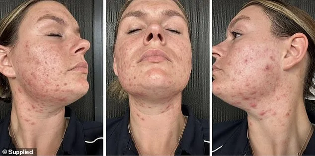 Tara Dekker's Hidden Battle: The Emotional Toll of Adult Acne