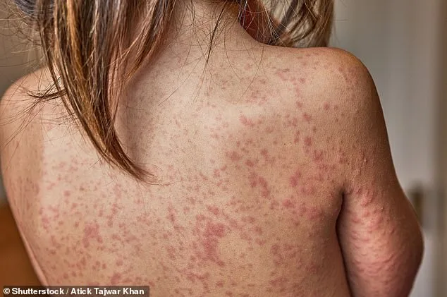 Trump Administration Urges Measles Vaccination Amid South Carolina Outbreak as 93% Vaccination Rate Falls Short of Herd Immunity Threshold
