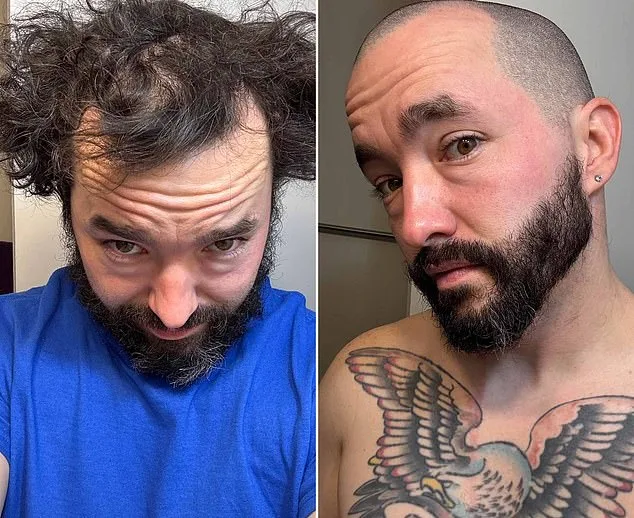 r/bald: A Digital Oasis of Encouragement and Positivity in the Fight Against Baldness