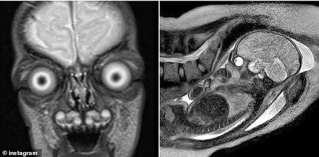 Fetal MRI Images Fuel Debate on Safety in Pregnancy