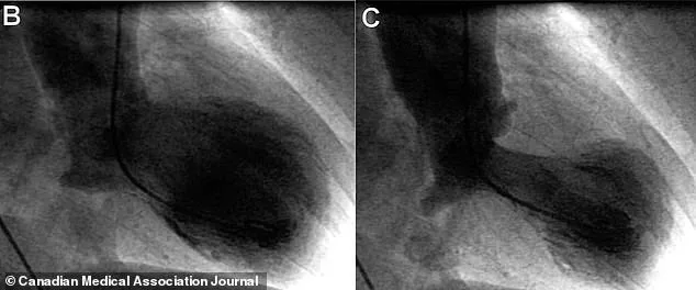 Mysterious Broken Heart Syndrome: Mimicking Heart Attacks in the Healthiest