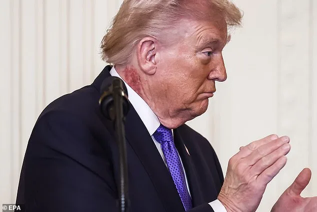 Trump's Rash Attributed to Preventative Treatment, Says Doctor