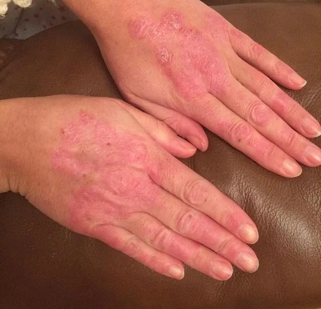 Janine Price's 20-Year Battle with Psoriasis: From Pain and Embarrassment to Hope for Millions