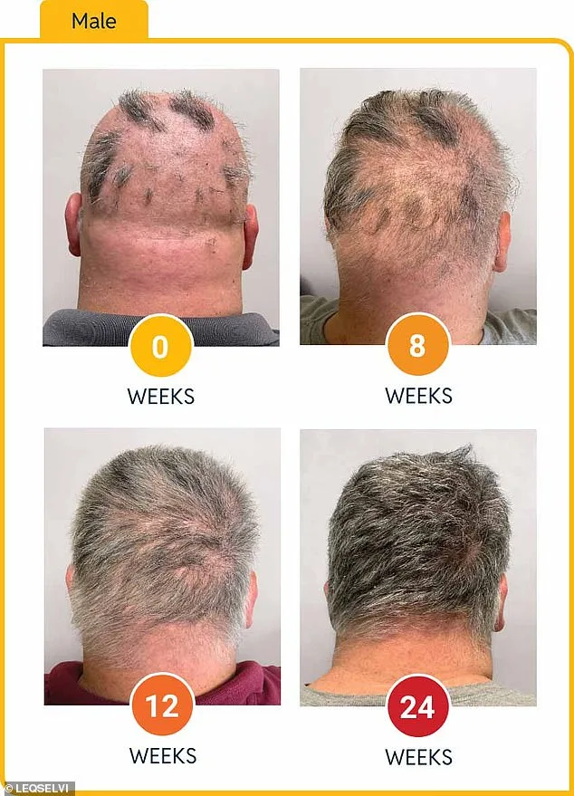 UK Approves Groundbreaking Treatment for Severe Alopecia Areata