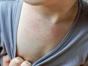 HMPV Surge Sparks Health Alert: CDC Data Shows 5% of Respiratory Tests Positive as No Vaccine Exists