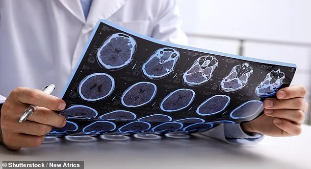 MS Cases Surge in England Amid Rising Mortality Risks from Smoking, Obesity, and Deprivation