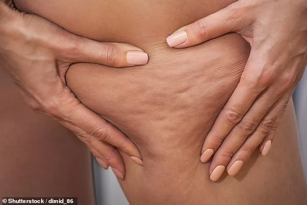Lipoedema: The Hidden Condition Affecting 1 in 10 Women, Spotlighted by Celebs Like Doja Cat