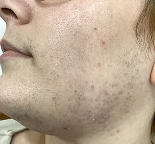 More Than a Cosmetic Issue: The Hormonal Journey of Women Dealing with Hirsutism in the UK