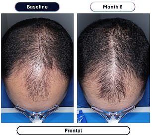 New drug quadruples hair regrowth results in clinical trials
