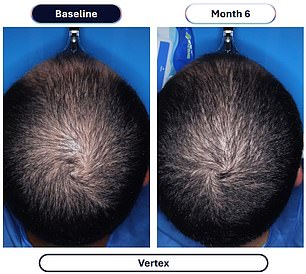 New drug quadruples hair regrowth results in clinical trials