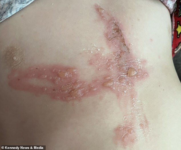 Six-year-old boy suffers severe burns mistaking giant hogweed for a toy axe.