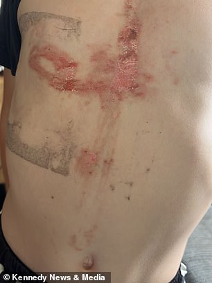 Six-year-old boy suffers severe burns mistaking giant hogweed for a toy axe.