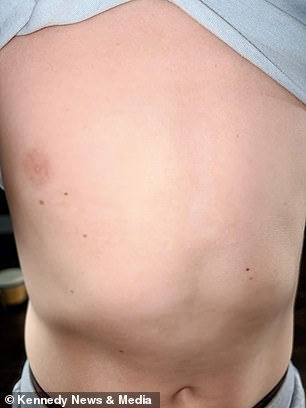 Six-year-old boy suffers severe burns mistaking giant hogweed for a toy axe.